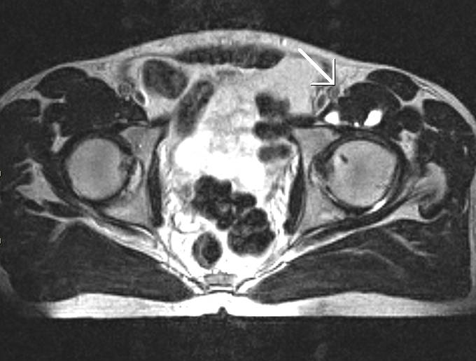 Knuckle Bursitis