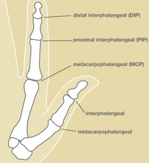 Knuckle Bursitis